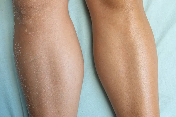 前と後の保湿剤を使用して ベッドの上に横たわる女性の足の乾燥肌と保湿肌の閉じる — ストック写真