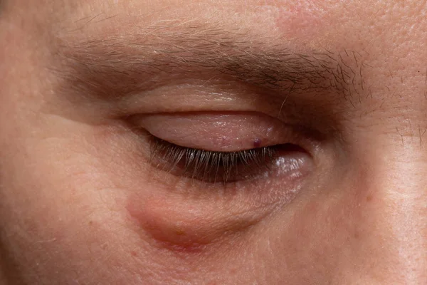 Swollen eyes from tiredness and irritation. Closeup of a woman\'s eye with bags under the eyes.