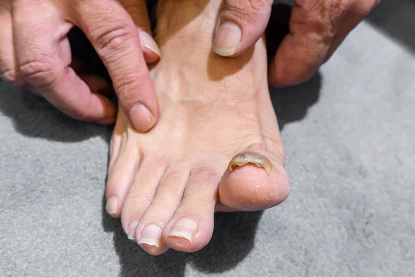 一个光着脚 脚趾甲又大又黄又厚的男人的特写镜头 还有一种念珠菌病 一种趾甲的真菌感染 — 图库照片