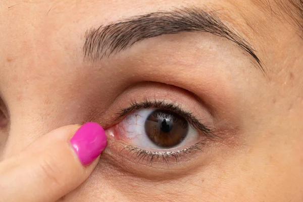 Macro Olho Mulher Com Capilares Vermelhos Dedo Indicar Vermelhidão Conceito — Fotografia de Stock