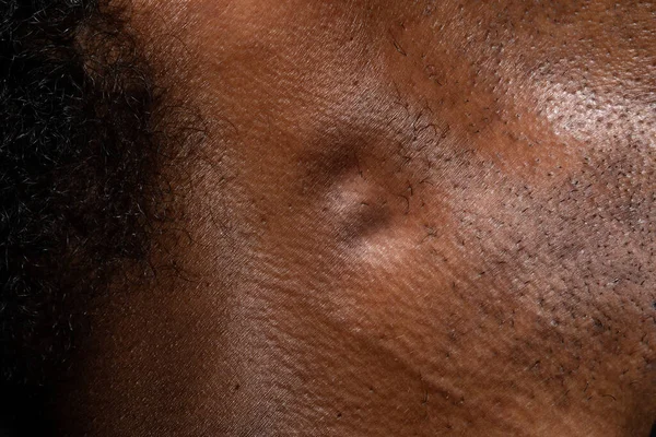 Macro of swollen lymph nodes in the neck of an African man, immune response of the lymphatic system or the possibility of malignancy