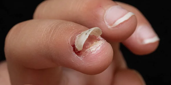 Macro Fingers Child Who Losing Fingernail Trauma — Stock Photo, Image