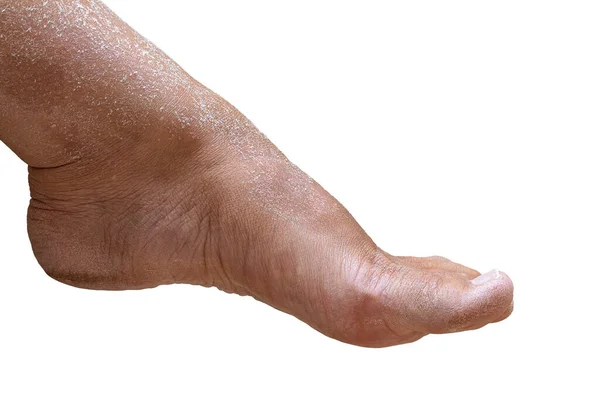 Tamamen Susuz Kadın Ayağı Kabuğu Soyulmuş Kuru Deri Kırışıklıklar Beyaz — Stok fotoğraf
