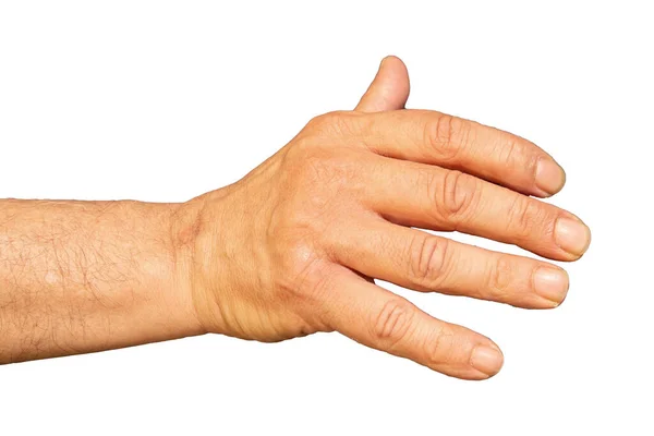 Male Hand Unable Open Fully Due Deforming Arthritis Isolated White — Stock Photo, Image