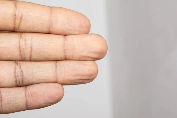 Los Dedos Arrugados Una Mano Masculina Debido Deshidratación Debido Estancia — Foto de Stock