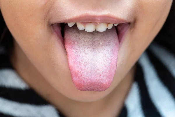 口腔衛生や栄養不良のために細菌のパチナを持つ少女の舌のクローズアップ — ストック写真