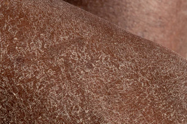 Makro Detail Suché Kůže Nohou Africké Ženy Selektivní Zaměření Dehydratované — Stock fotografie