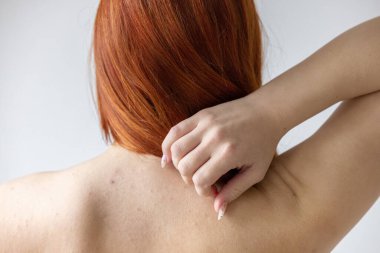 Dermatolojik sorunu ve sivilcesi olan kızıl saçlı beyaz bir kız. Sivilceli cilt. Arkadan bir kadın, tanınmaz halde.