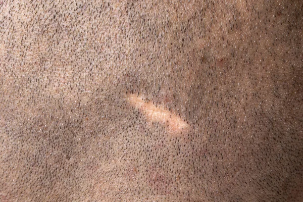 Macro of a scar on the scalp of a man with shaved hair. Concept of surgery and scar tissue. Operation on the head of an adult man.