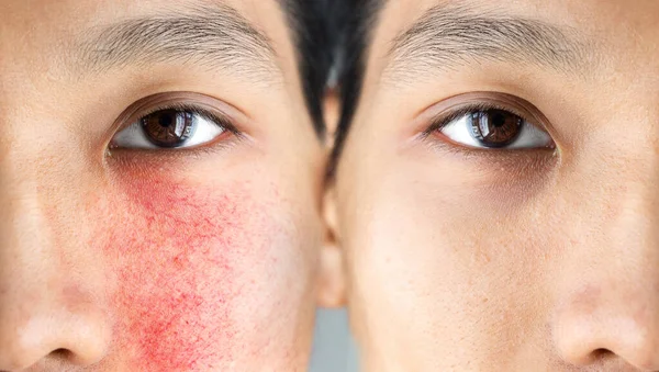 前とアジアの男性の顔におけるアクニフォーム酒の治療後 頬や若いアジア系の男の上にクーペ — ストック写真