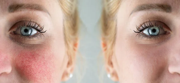 Successful Rosacea Treatment Face Caucasian Lady Redness Visible Blood Vessels — Stock Photo, Image