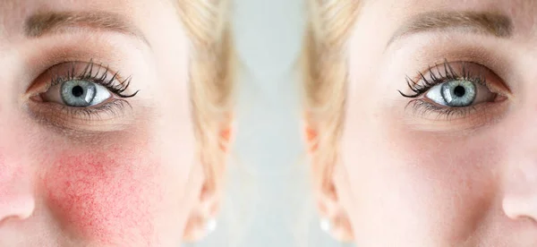 白人女性の顔に成功した酒の治療の前と後 赤さと目に見える血管はすべてレーザー手術で除去されます — ストック写真