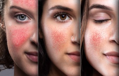 Rosacea ya da couperose hastası kızların yüzlerinin yarısı. Sinirli kılcal damarların kırmızı yanakları ve burnu. Derideki kızarıklığı ve iltihabı azaltmak için lazer tedavisi kavramı.
