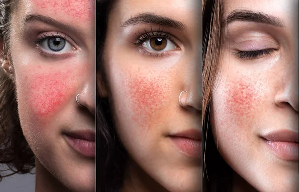 Half Faces Girls Suffering Rosacea Couperose Red Cheeks Nose Irritated — Stock Photo, Image