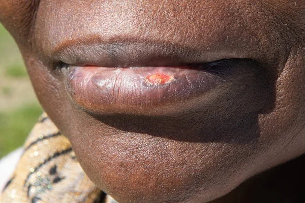 Macro of a cold sore in an African woman. Close up of lips with Herpes simplex causing yellow pustules and black spots.