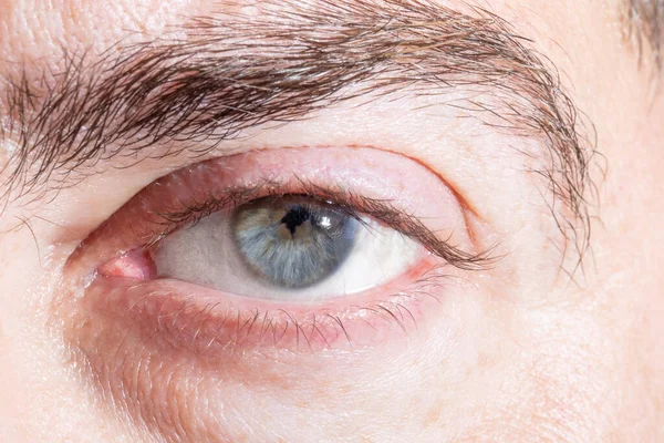 Macro Ojo Humano Masculino Con Una Pupila Irregular Dentada Después —  Fotos de Stock