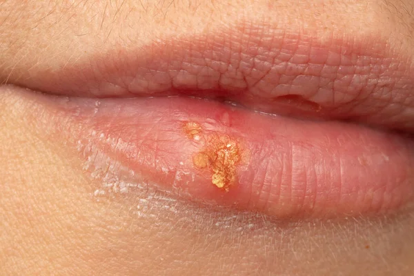 Makro Kobiecych Ust Opryszczką Opryszczka Krosty Simplex Zbliżenie Kobiecych Ustach — Zdjęcie stockowe