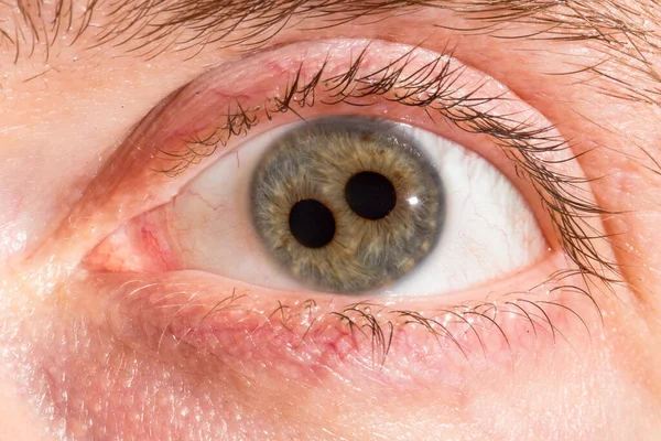 Makro Ludzkiego Oka Podwójną Tęczówką Zbliżenie Dwóch Źrenic Wrodzona Choroba — Zdjęcie stockowe