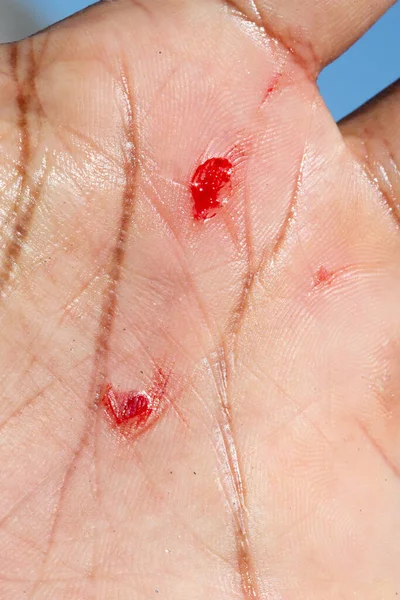 Bleeding wound on a man\'s hand following an accident. Macro of cuts on human skin with blood loss. Work accidents concept.