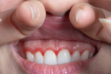 Bir kadının kırmızı diş etlerinin makroları. Kızarıklıkla birlikte sakız iltihabı. Kanayan diş etleri gösteren genç bir kadının görüntüsü. Diş sağlığı, diş bakımı ve ağız temizliği kavramları.