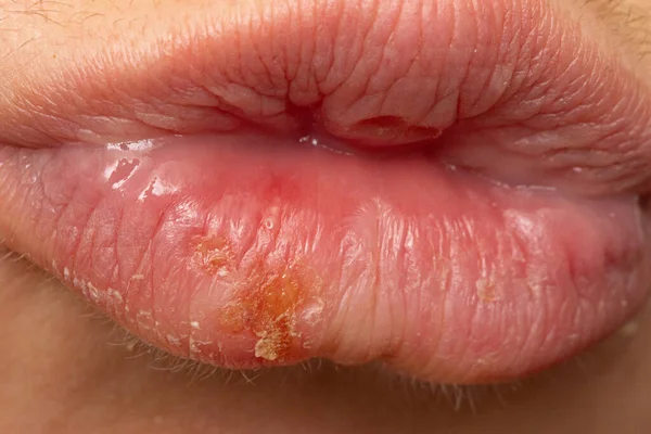 Makro Der Lippen Von Frauen Mit Lippenherpes Herpes Simplex Pusteln — Stockfoto