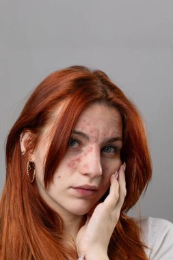 Young woman with acute skin rash on her face. Dermatological problems due to allergy, hypersensitivity or anaphylactic shock. Red skin with rash or eczema clipart