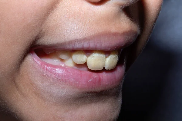 İhmal edilmiş bebek dişleri, plaka, tartar ve siyah mantarlı. Bakteriyel enfeksiyon riski olan kötü ağız temizliği durumu.