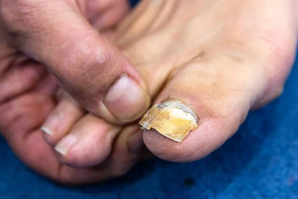 Makro Ludzkiego Paznokcia Infekcją Grzybiczą Duży Palec Nogi Zaawansowaną Onychomykozą Obrazy Stockowe bez tantiem