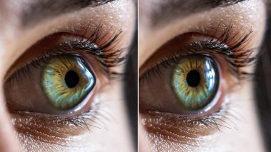 Macro before and after surgery of a clear female eye of a Caucasian woman suffering from keratoconus. A cone-shaped deformation of the cornea clipart