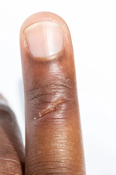 A macro shot showcases the details of a healing scab on a finger, highlighting skin texture and care