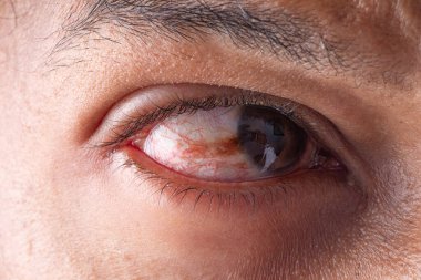 Pterygium olarak bilinen bir göz durumunun ayrıntılı görüntüsü