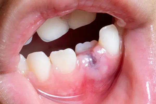 stock image Close-up of inflamed gums showing a dental abscess and tooth decay, highlighting oral health issues and the importance of dental care