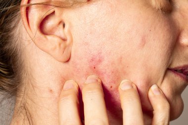 Rosacea 'dan muzdarip beyaz bir kadının asabi yüzüne dokunuşunun yakın çekimi.