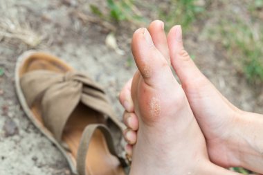 Yürüyüşten sonra ağrıyan ayağını tutan kadın, acı ve rahatsızlıktan muzdarip.