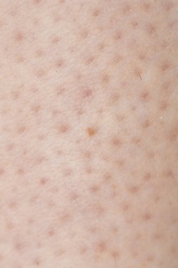 Close up of skin showing folliculitis, inflammation of the hair follicles clipart