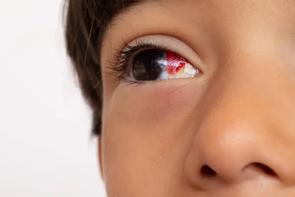 stock image Close-up of child with subconjunctival hemorrhage in eye, showing redness in sclera