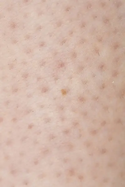 Stock image Close up of skin showing folliculitis, inflammation of the hair follicles