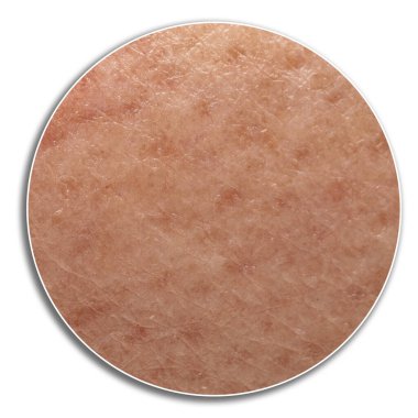 Uva uvb ışınlarına uzun süre maruz kaldıktan sonra cilt kapama veya yerel noktalar ve zayıf gözenekler ve benler. Büyütme çemberi