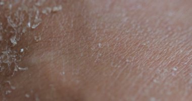 Bir kadının bacağındaki kuru deriyi kapatın. Kozmetik ürünlerle dehidrasyon ve cilt bakımı kavramı.