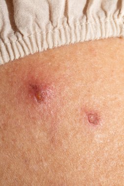 Yaşlı bir kadının gövdesindeki kiremitlerin sebep olduğu acı dolu kırmızı kabarcıklara yakın çekim.