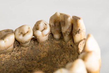 Diş minelerinin çürüdüğünü ve çene kemiğinin bozulduğunu gösteren kadim dişler, diş sağlığı ve hijyen uygulamaları hakkında bilgi sağlıyor.