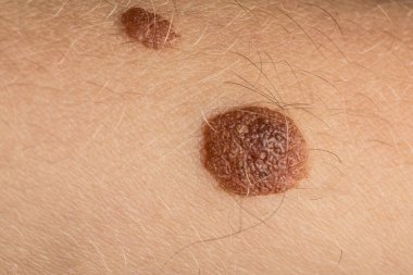 Close-up of seborrheic keratosis, a common noncancerous skin growth, on arm skin clipart