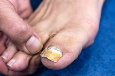 Ciddi bir ayak tırnağı mantarı vakası ile hastanın ayağını muayene eden tıbbi uzman teşhis ve tedavi ihtiyacını vurguluyor.