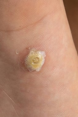 Salisilik asit tedavisi başarılı bir şekilde ayak derisindeki bir plantar siğilini çıkartıyor.