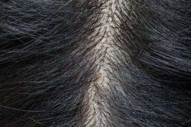 İncelen saç ve kafa derisi problemleri, saç folikülleri ve deriyi gösteriyor.