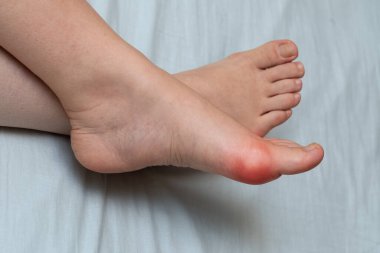 Ayağında şişlik, yanında kızarıklık ve şişkinlik var.