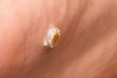 İnsan derisindeki plantar siğilinin detaylı görüntüsü