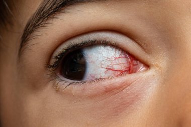 Kılcal damarlar ve tahriş, göz alerjisi, konjonktivit ya da kuru göz sendromu gösteren kırmızı gözün yakın çekimi.