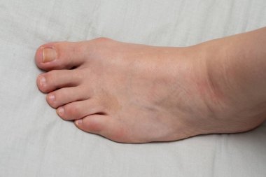 Kadının ayağının yakın çekimi hallux valgus 'u gösteriyor, yaygın bir ayak deformasyonu.