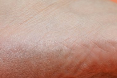 Kuru cilde yakın çekim, dokusunu vurgulamak ve nemlendirme ve bakım ihtiyacı